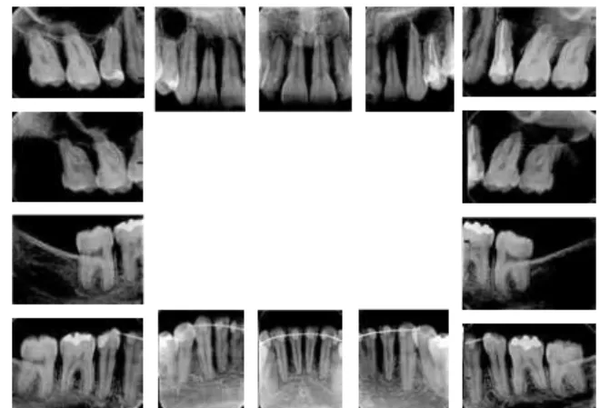 FIGURE 13 - Final lateral cephalometric radiograph (A) and cephalometric tracing (B). 