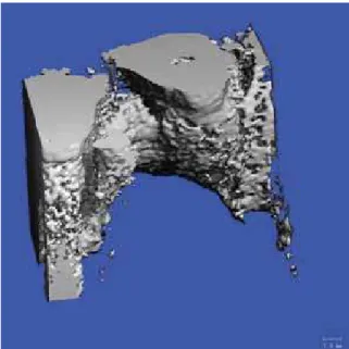 FIGURE 2 - Cone beam computed tomography (CBCT) of alveolar  bone graft.