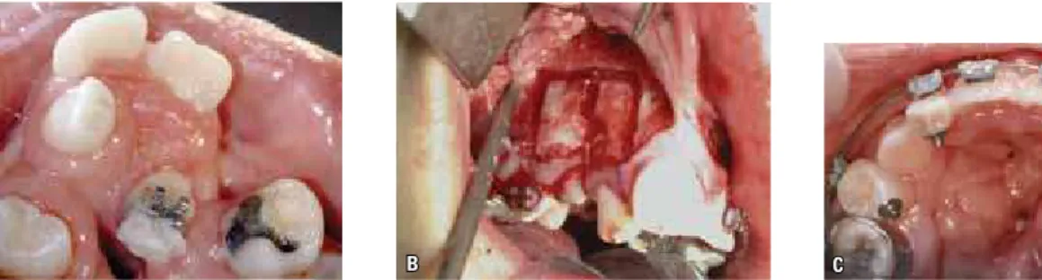 FIGURE 4 - Pre-corticotomy ( A ), reshaping of dental arch with buccal corticotomies ( B ), post-corticotomy ( C ).