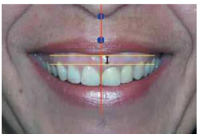 FIGURE 2 - Illustration of the method to create images with different lev- lev-els of gingival display.