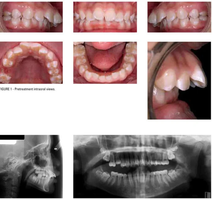 FIGURE 2 - Pretreatment lateral cephalometric and panoramic radiographs.