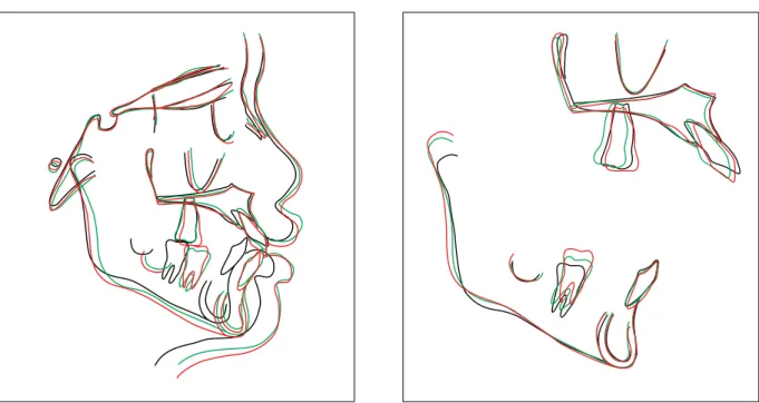 FIGURE 10 - Superimposition of pretreatment, midtreatment and post-treatment cephalometric tracings.