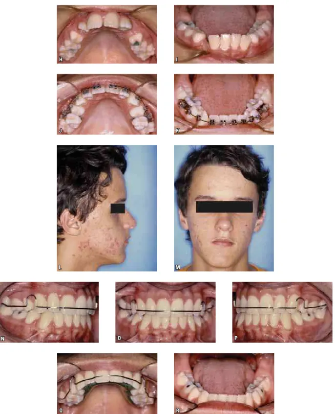 FIGURE 1 - Patient treated with serial extraction orthodontic mechanics. First phase of serial extraction involved extraction of deciduous canines in the  first transitory period of mixed dentition