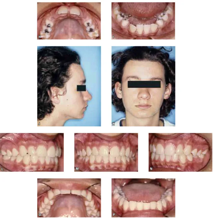 FIGURE 2 - Patient having undergone only extraction of deciduous teeth (reversible phase)