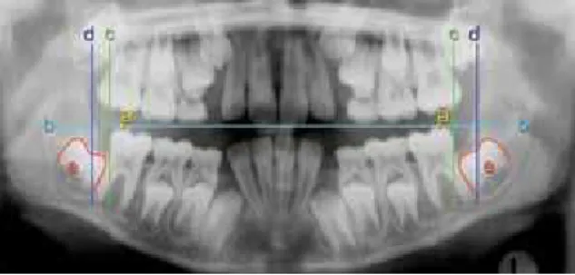 FIGURE 3 - Tracing on panoramic radiograph showing reference lines  used to measure retromolar space; (a) tip of distal cusp of first molar; 