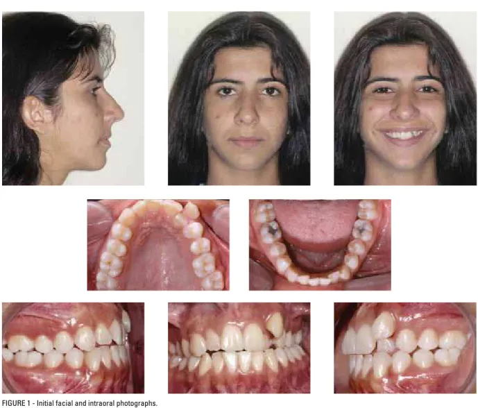 FIGURE 1 - Initial facial and intraoral photographs.