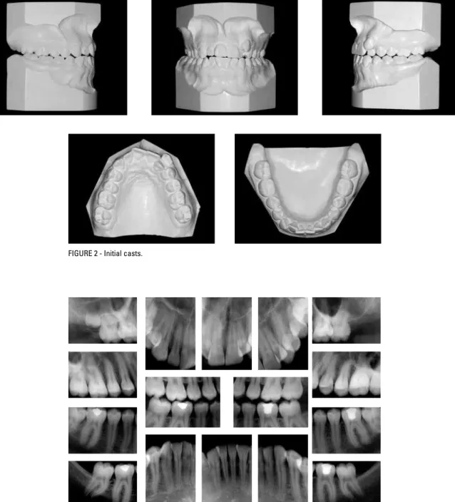 FIGURE 3 - Initial periapical radiographs.