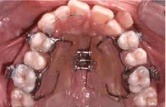 FIGURE 5 - Occlusal photograph of  the modified Haas expander.