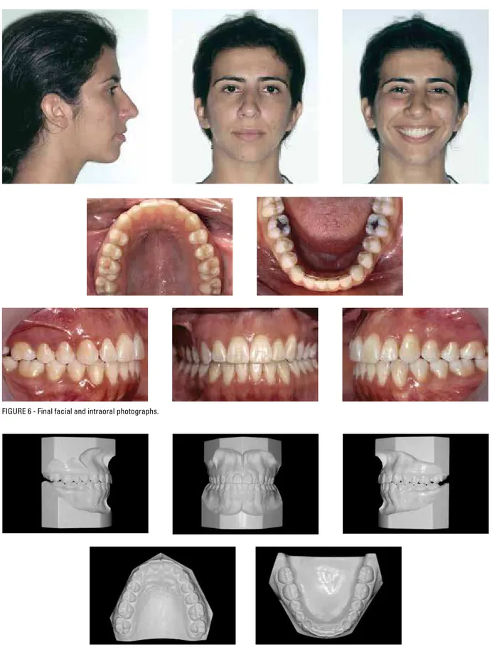 FIGURE 7 - Final casts.