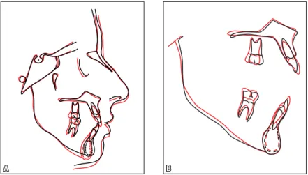 FIGURE 10 - Total ( A ) and partial ( B ) superimpositions of initial (black) and final (red) cephalometric  tracings.