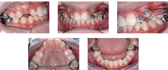FIGURE 28 - The outcome was satisfactory and, within the context, considered likely. After ten months deploying the mechanics to correct the malposition of  teeth #22 and #23, a case of moderate complexity emerges to be treated with a fixed orthodontic app
