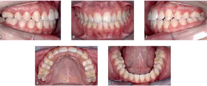 FIGURE 30 - The final outcome is a high quality occlusion attained through a simple, conventional orthodontic treatment