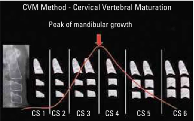 FIGURE 1 - Using the cervical vertebral maturation (CVM) method devel- devel-oped by Baccetti T, Franchi L and McNamara Jr