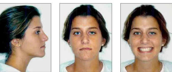 FIGURE 6 - Pattern III patients diagnosed as Pattern I by 68.75% of raters. Height of lower lip and chin increased relative to upper lip height allows discrep- discrep-ancy identification even in front view photograph.