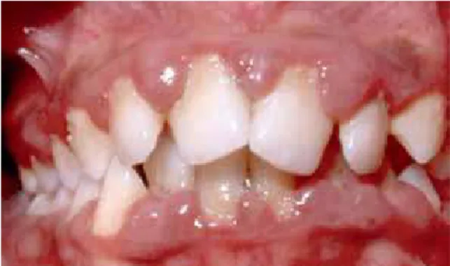 FIGURE 1 - Clinical aspect  of malocclusion in mixed dentition, with em- em-phasis on tooth 41 proclined and with gingival recession.