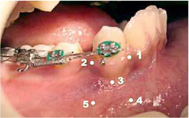 FIGURE 1 - Points for laser application at the buccal surface: 1) mesiobuccal  gingival ridge; 2) distobuccal gingival ridge; 3) buccal central point - central  in relation to the other points; 4) bottom of oral vestibule, at the same vertical  direction o