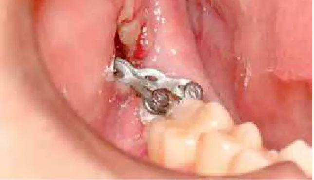 FIGURE 3 - Fixation of miniplate and screws in retromolar region/man- region/man-dibular ramus