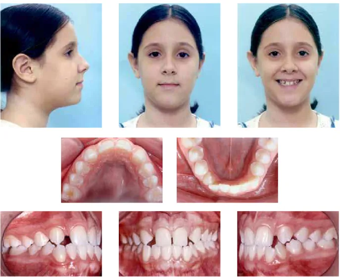 FIGURE 1 - Initial facial and intraoral photographs.