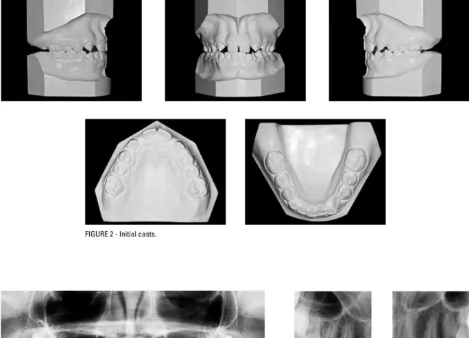 FIGURE 3 - Panoramic (A) and periapical (B) radiographs.