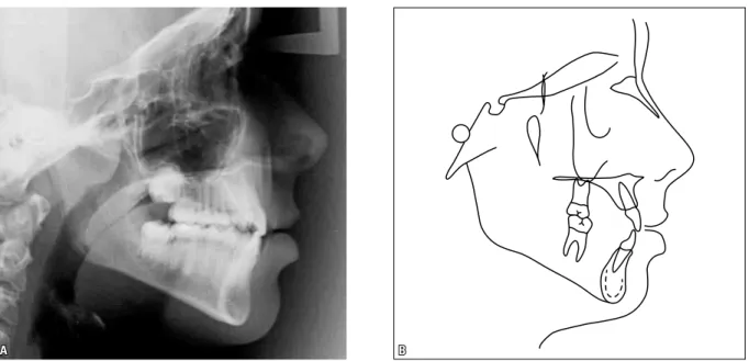 FIGURE 4 - Initial lateral cephalometric radiograph ( A ) and cephalometric tracing ( B ).