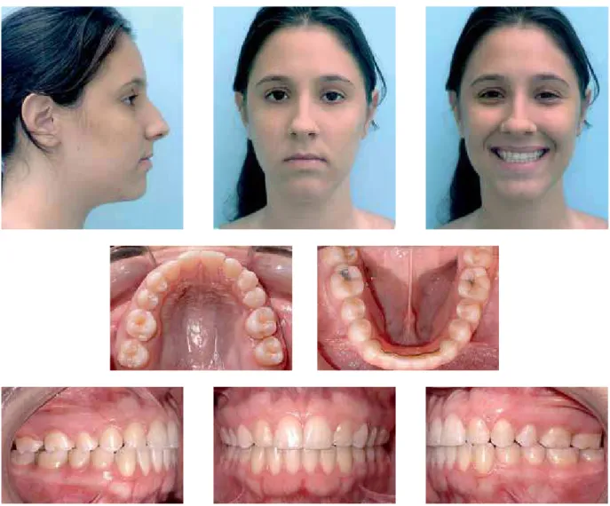FIGURE 5 - Facial and intraoral final photographs.