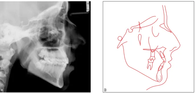 FIGURE 8 - Final lateral cephalometric radiograph ( A ) and cephalometric tracing ( B ).