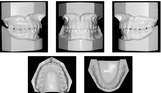 FIGURE 2 - Initial dental casts of Class II malocclusion case, accurately trimmed. 5 