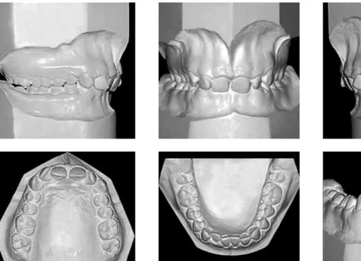 FIGURE 4 - Panoramic radiograph ( A ) and periapical radiograph of maxillary and mandibular incisors ( B ).