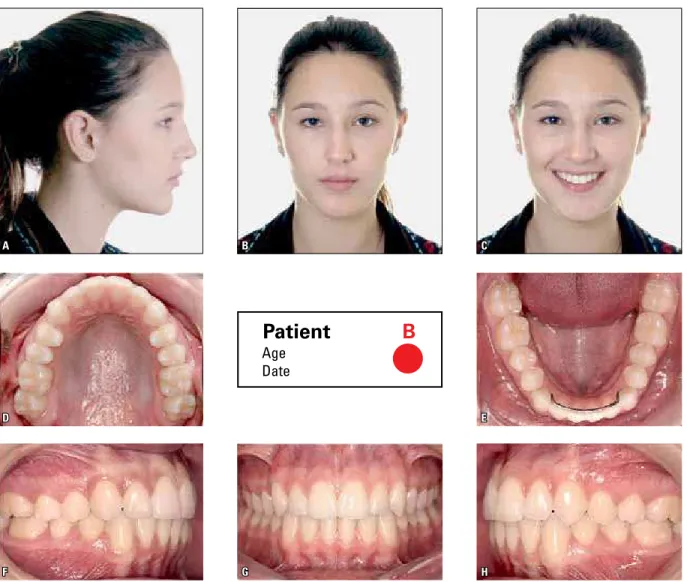FIGURE 9 - Photograph layout:   A ,  B ,  C ) facial - right-side profile, frontal and frontal smiling photographs;  D ,  E ,  F ,  G, H ) intraoral - upper occlusal, lower  occlusal, right lateral, frontal and left lateral photographs.