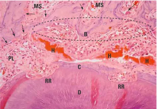 FIGURE 7 - Indirect bone resorption (arrows) on mesial face of murine M1 st M distobuccal root after application of in- in-tense forces for 9 days