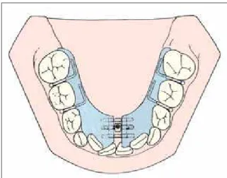 FIGURA 1 - Expansor maxilar fixo com splint de acrílico, usado preferen- preferen-cialmente em pacientes em dentição mista, é representativo dos  apare-lhos ortopédicos de expansão usados durante o tratamento
