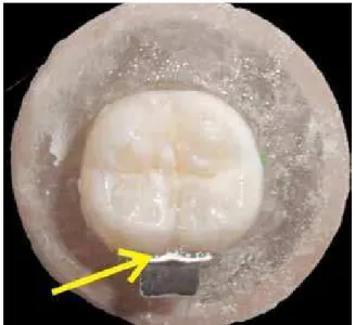 FIGURE  4  -  Test  specimens  in  Group  1:  Con- Con-ventional  direct  bonding  followed  by   appli-cation of additional layer of resin to occlusal  surfaces of the tube/tooth interface.