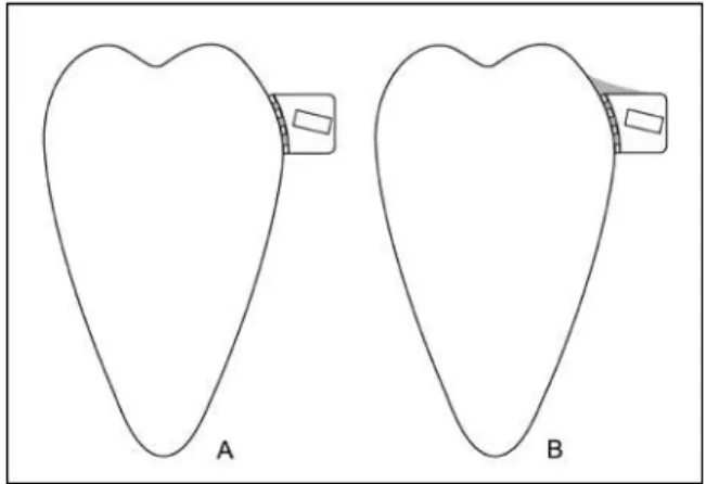 FIGURE 7 - A) Conventional direct bonding; B) Enlargement of resin area  to increase bond strength of whole tube/resin/tooth set.