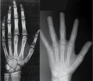 FIGURE 1 - Comparison of hand and wrist radiograph of 10-year-old girl  and the corresponding standard in the Greulich &amp; Pyle atlas 7 .