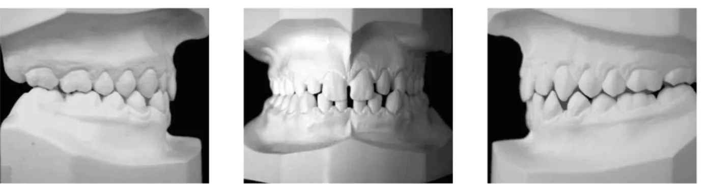 FIGURE 1 - Plaster casts of an individual with Class I malocclusion used in the sample.
