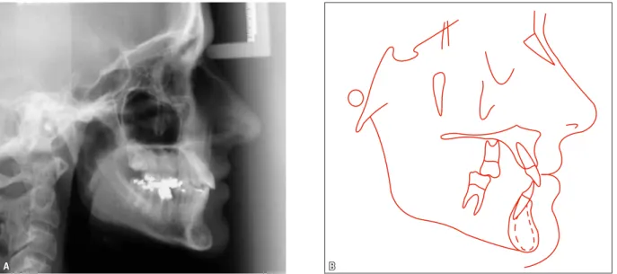 FIGURE 8 - Final cephalometric profile radiograph ( A ) and cephalometric tracing ( B ).