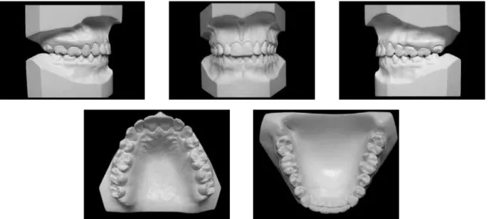 FIGURE 11 - Control dental casts four years and five months after treatment completion.