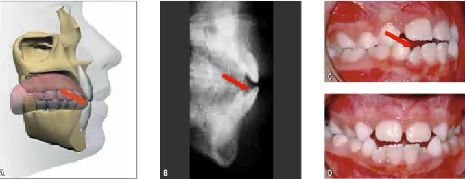 FIGURE 9 - Schematic ( A ), radiograph ( B ) and photographs ( C  and  D ) of low posture of the tongue at rest, associated with a moderate AOB