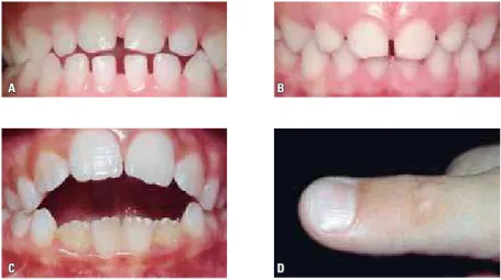 FIGURE 2 -  A ) AOB in primary teeth caused by pacifier sucking and  B ) spontaneous correction after  removal of habit