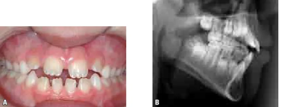 FIGURE 3 - AOB caused by poor posture of the tongue at rest and lip interposition ( A )