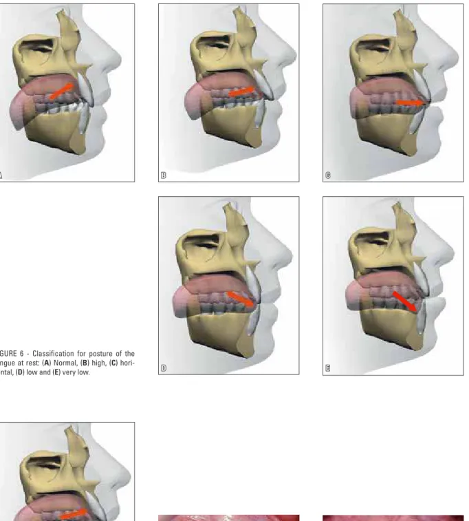 FIGURE 6 - Classification for posture of the  tongue at rest: ( A ) Normal, ( B ) high, ( C )  hori-zontal, ( D ) low and ( E ) very low.