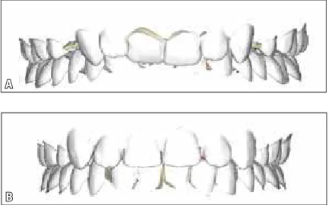 FIGURE 2 -  a ) Initial scanned model and  B ) virtual setup of the Orapix System.