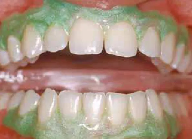 FIGURE 4 - Protective resin dam applied to cervical region; it drastically  reduces or prevents contact of whitening product with gingival mucosa  and cementoenamel junction.
