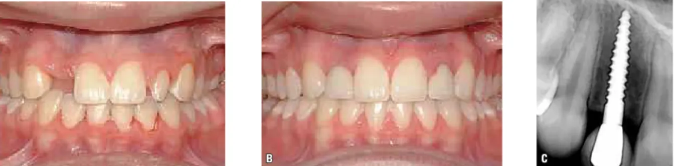 FIGURA 10 - Substituição provisória do incisivo lateral:  A ) anteriormente à colocação do mini-implante;  B ) cinco anos após a colocação do incisivo  lateral provisório;  C ) radiografia periapical da região de controle após cinco anos.