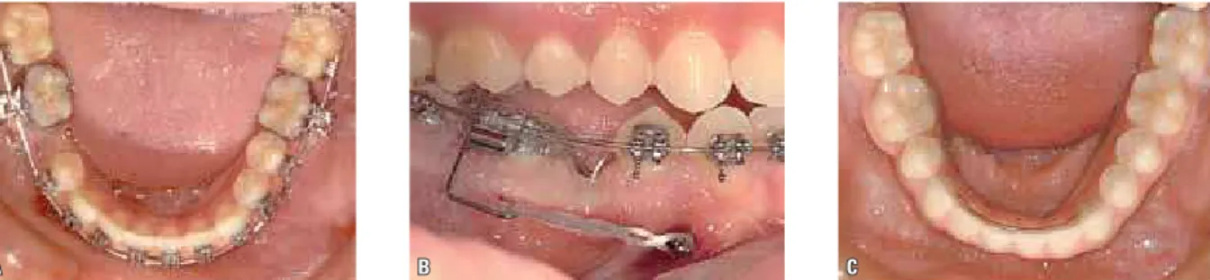 FIGURA 1 - Mesialização dos dentes posteriores para eliminar a necessidade de restauração, devido à ausência congênita de dentes