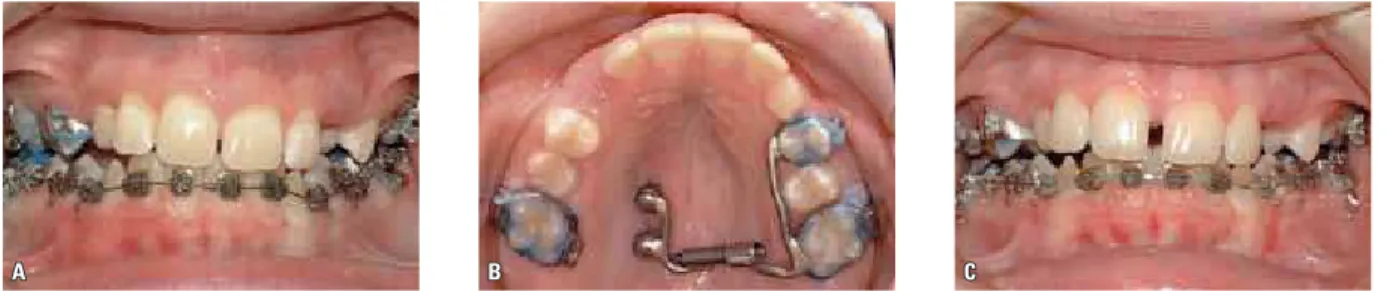 FIGURA 7 - Intrusão da arcada superior para correção do sorriso gengival usando quatro mini-implantes:  A ) colocação dos DATs na região anterior; 