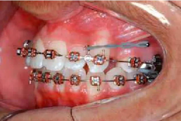 FIGURE 1 - Self-drilling mini-implant installed in between the upper  first  and  second  premolars  as  an  anchorage  resource  for  anterior  retraction.