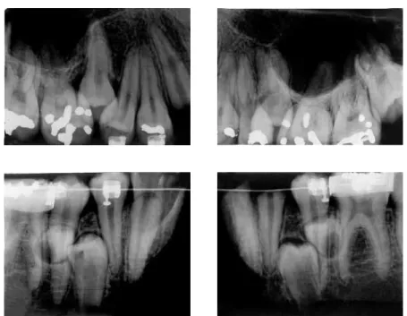 FIGURE 3 - Postmortem radiographs show supernumerary teeth in maxillary and mandibular arches,  as well as brackets and bands in mandibular molars.