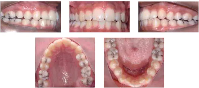 FIGURE 5 - Intraoral photographs taken for orthodontic treatment (2005).