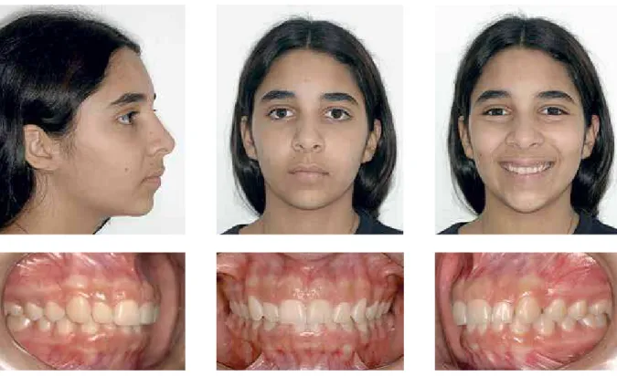FIGURE 15 - Clinical case 1 – Initial facial and dental aspects.
